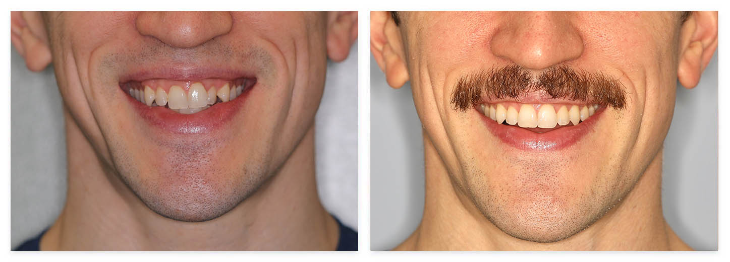 Invisalign Before and After
