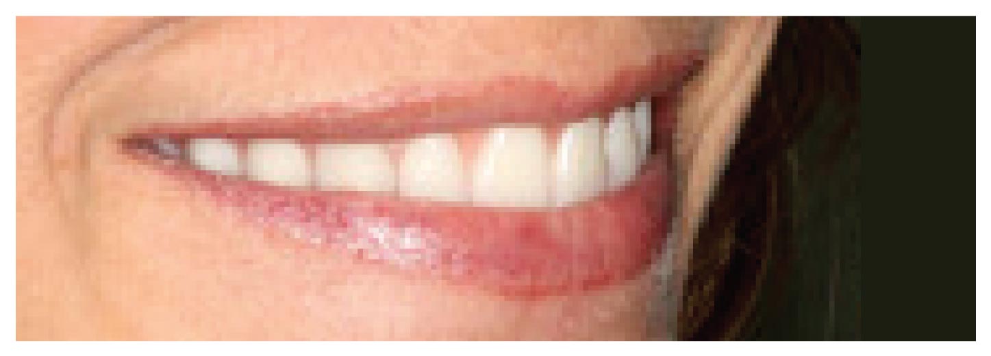 Rejuvenating Dentures After Picture