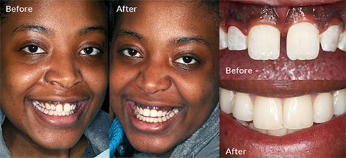 Smile Makeover before and after image