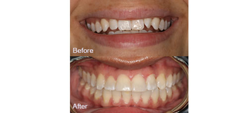 Smile Makeover before and after image