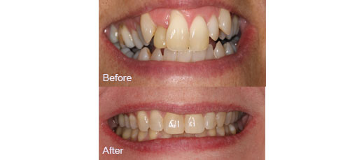 Smile Makeover before and after image