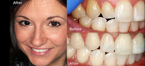 Smile Makeover before and after image
