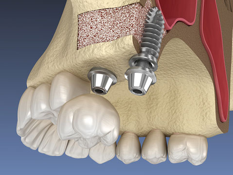 Render graphic of procedure of gum graft at Brush & Floss Dental Center 