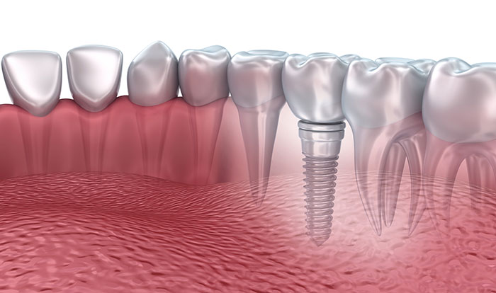 Rendering graphic image of dental implant from Brush & Floss Dental Center in Stratford, CT