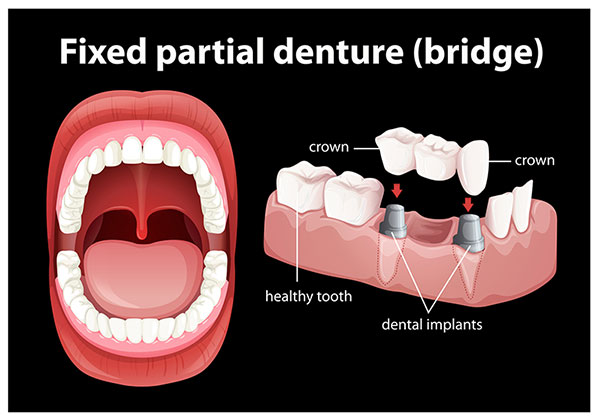 Implant bridge at Brush & Floss Dental Center Implant bridge at Brush & Floss Dental Center