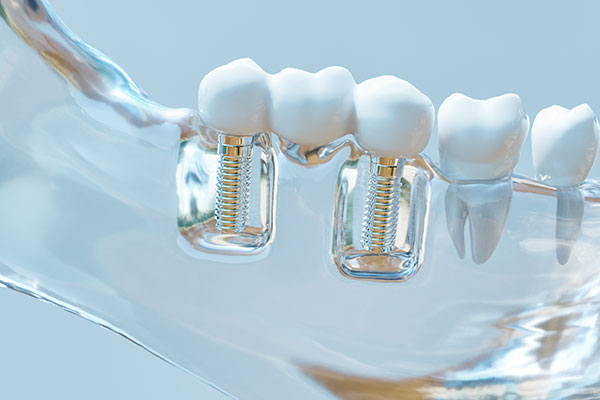 Mouth model of multiple teeth implants from Brush & Floss Dental Center in Stratford, CT