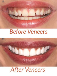 Porcelain Veneers before after