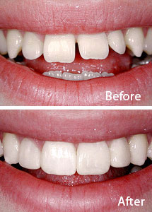 Porcelain Veneers before after
