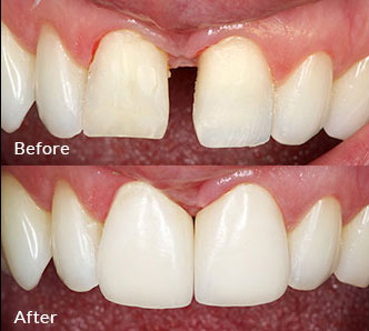 Porcelain Veneers before after