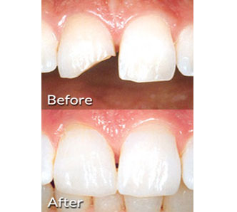 Porcelain Veneers before after