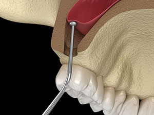 Rendering of Sinus lift at Brush & Floss Dental Center in Stratford, CT