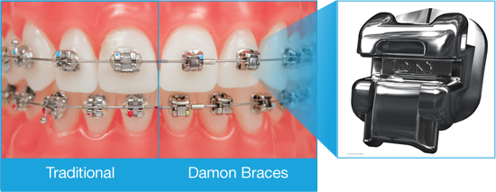 traditional and damon braces side by side