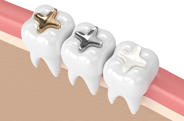  Rendering of teeth with 3 filling materials provided by Brush & Floss Dental Center in Stratford, CT