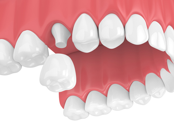 Rendering of jaw with dental crown from Brush & Floss Dental Center in Stratford, CT