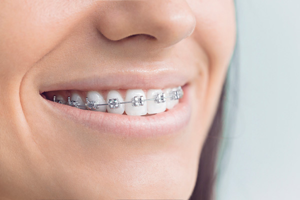 Close up of smiling woman in Stratford, CT with traditional metal braces from Brush & Floss Dental Center